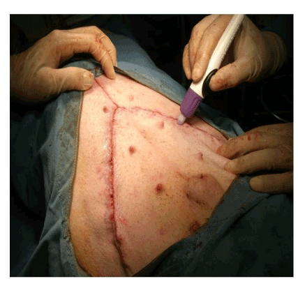 Dermabond Instructions