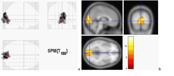 Fmri Sagittal