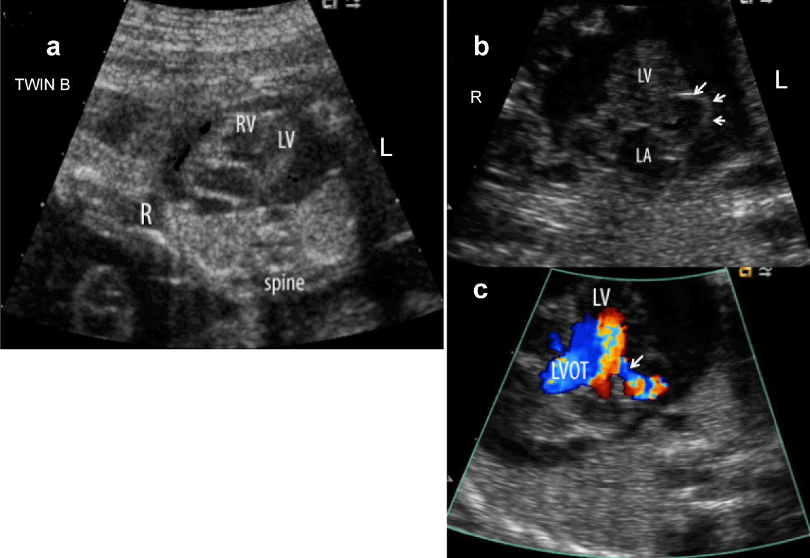 20-Week-Twin-Fetus Fetal Echocardiography and Prenatal Cardiovascular Interventions An ...