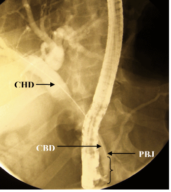 CBD common bile duct, common bile duct size. CBD common bile duct,