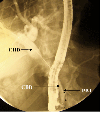 common bile duct cat. CBD common bile duct,