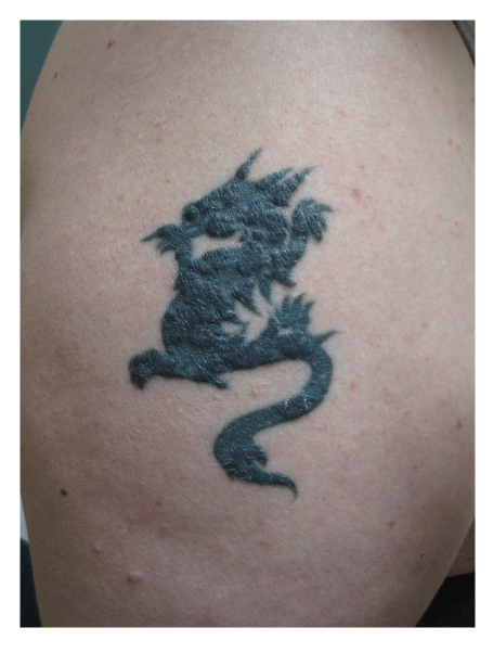 Figure Edematous Blue Pigmented Tattoo