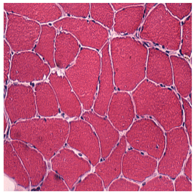 Spinal Muscular Atrophy on Of Lupus With Spinal Muscular Atrophy And Suspected Bronchial Cancer