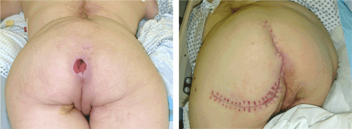pressure ulcers images #10