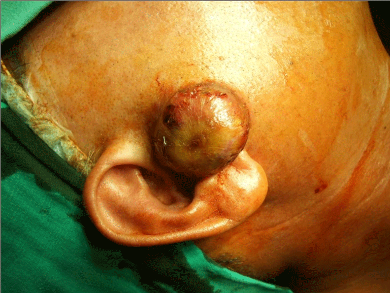 Help extreme sinus headache maxillary sinusitis ultrasound
