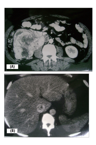 Replaced Right Hepatic. heterogeneous right renal