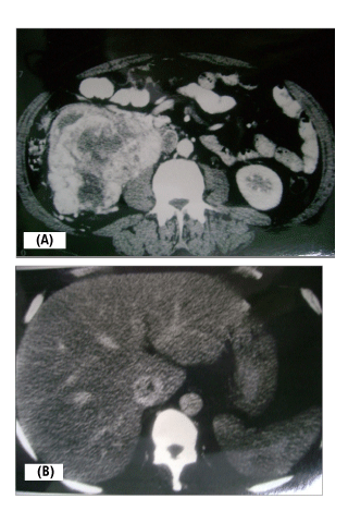 heterogeneous right renal Replaced Right Hepatic. heterogeneous right renal