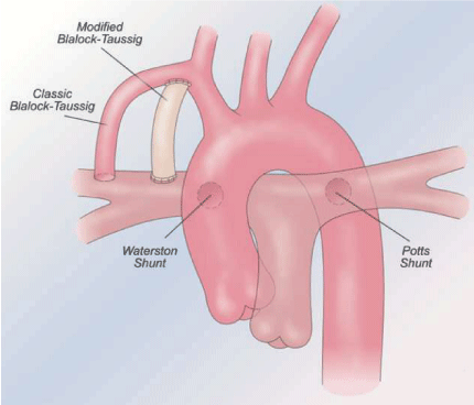 Tetralogy fallot in adults