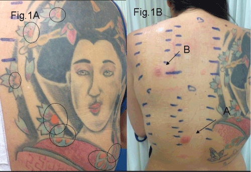 Allergic Contact Dermatitis from Aminoazobenzene in Tattoo Open