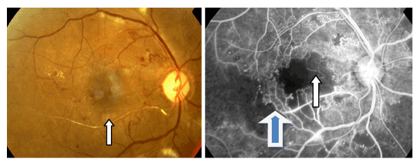 Current Management of Diabetic Maculopathy | Open Access | OMICS