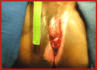 tumor