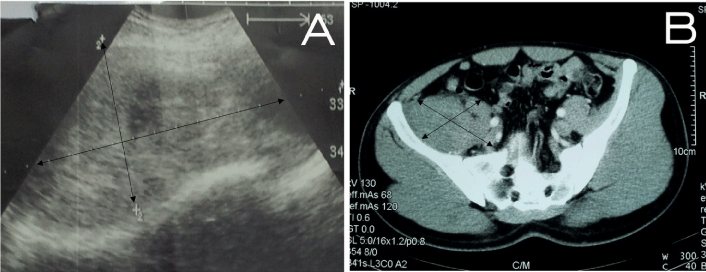 Ultrasound