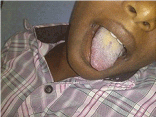 Respiratory Causes Of Central Cyanosis