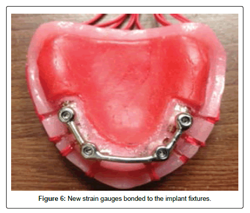 oral-hygiene-and-health-implant