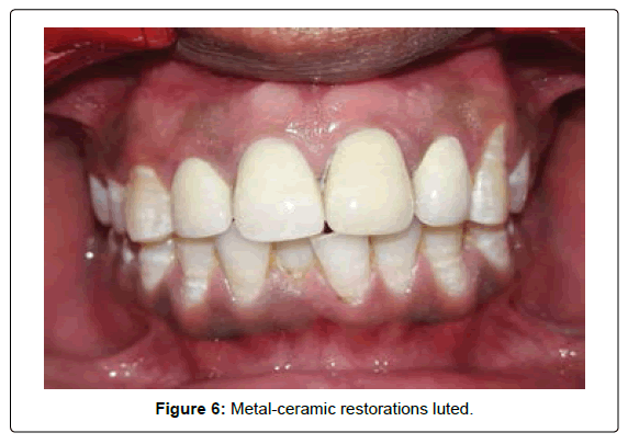 oral-hygiene-and-health-luted