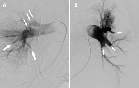 Angiography