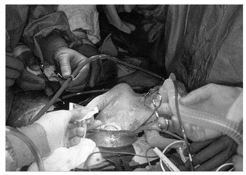 gestation