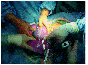 fetal