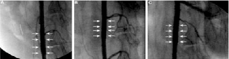 angiography