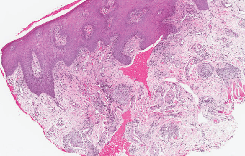 biopsy