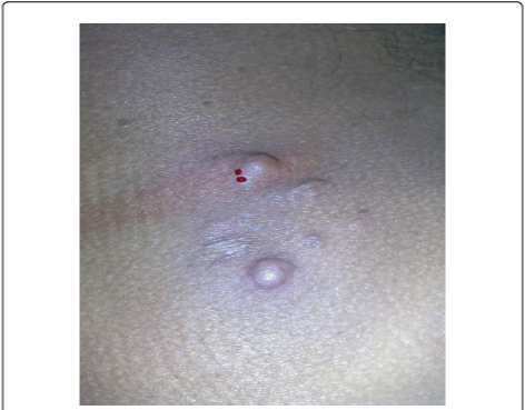 nodules