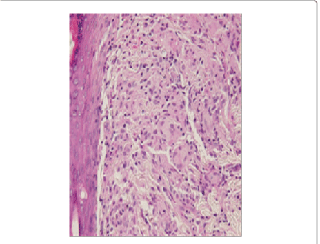 eosinophilic