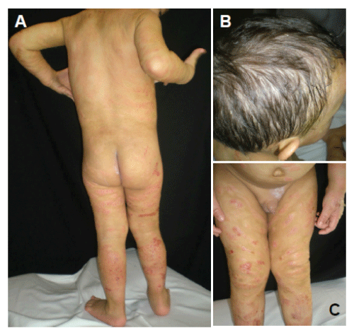Erythematous
