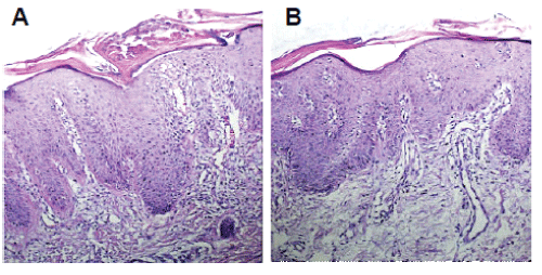 Biopsy