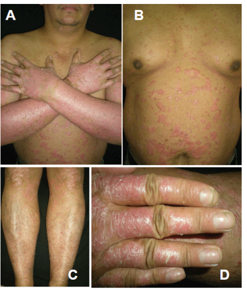 Psoriatic