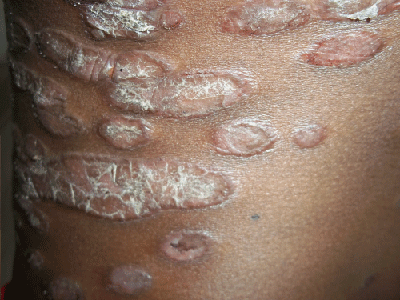 Erythrodermic