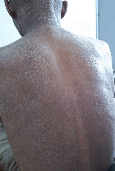 psoriasis