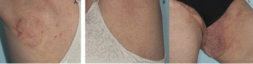 Granulomatous