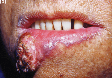 Squamous