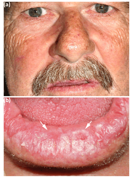 Diffuse