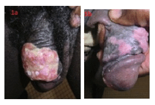 Showing ulcer was
