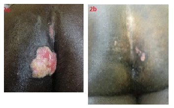 ulcer