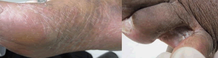 Tinea