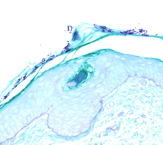 Tinea