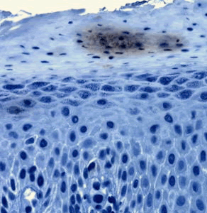 Tinea