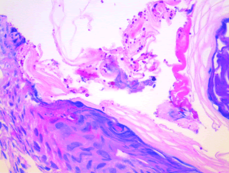 Seborrheic