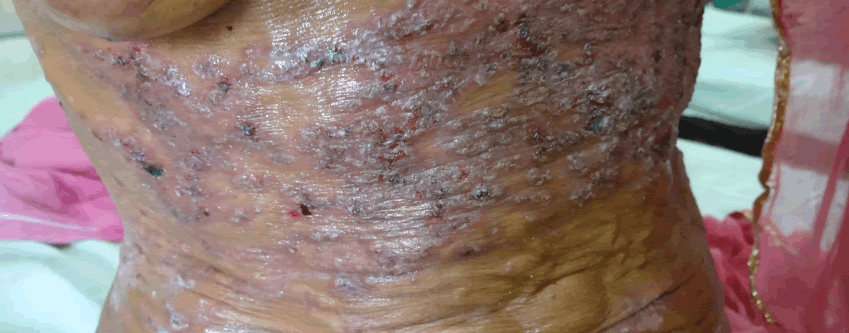 Crusted