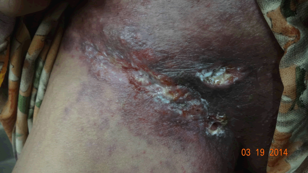 Inguinal