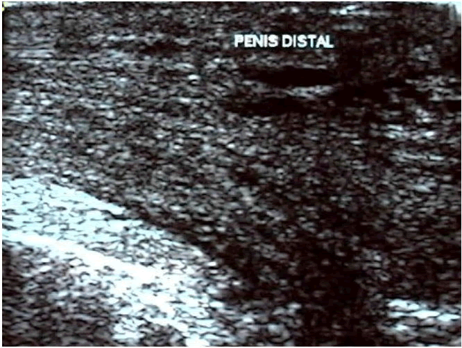 distal