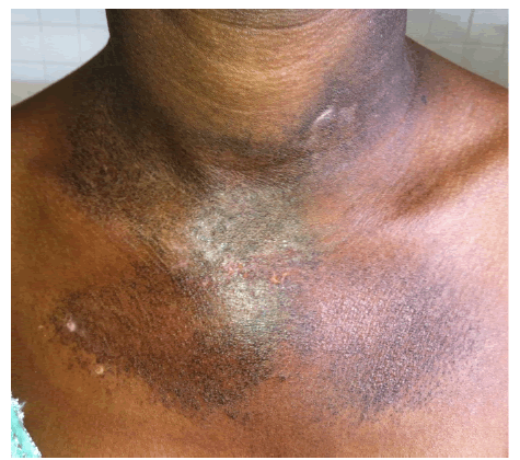 hyperpigmentation