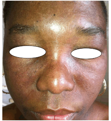 oedema