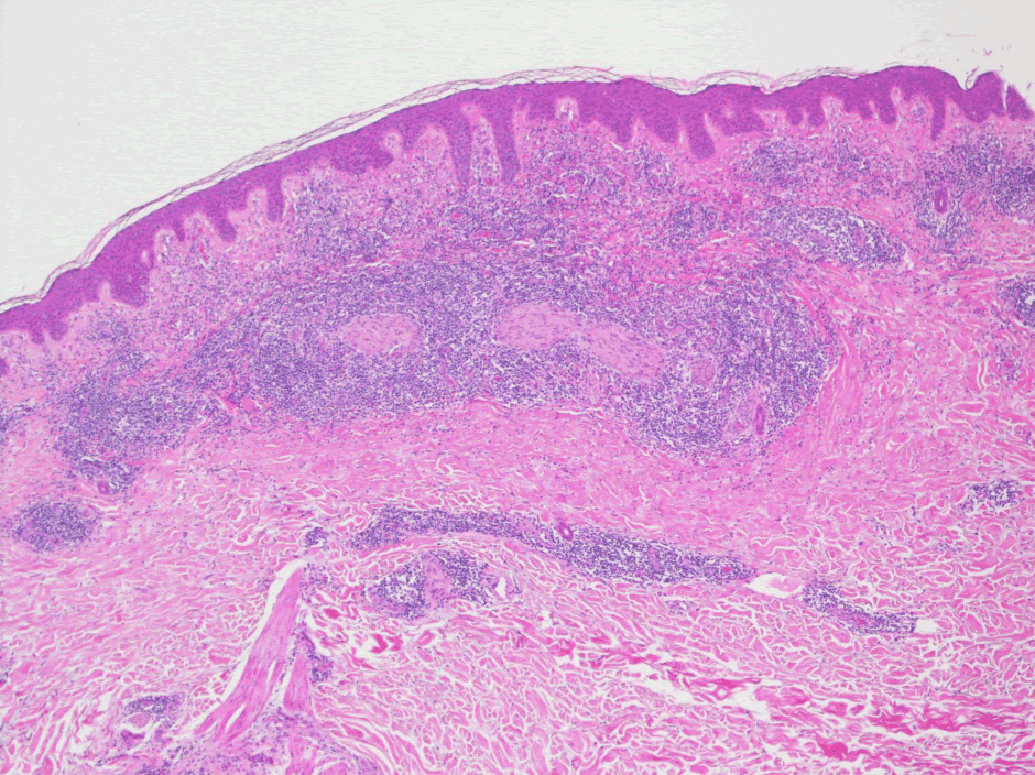 biopsy