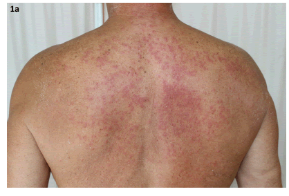 gabapentin drug eruption