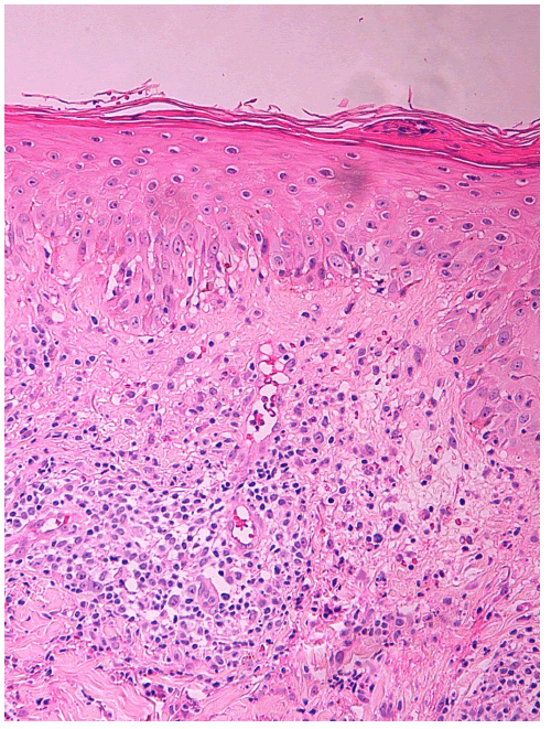 parakeratosis