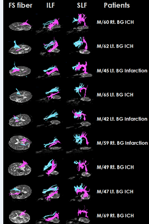 Subcortical