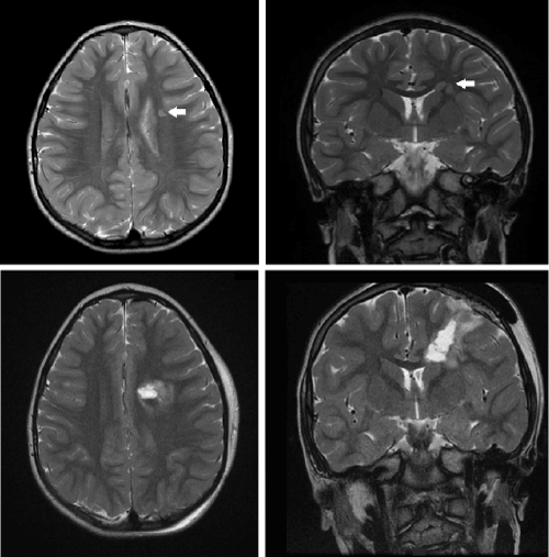 brain